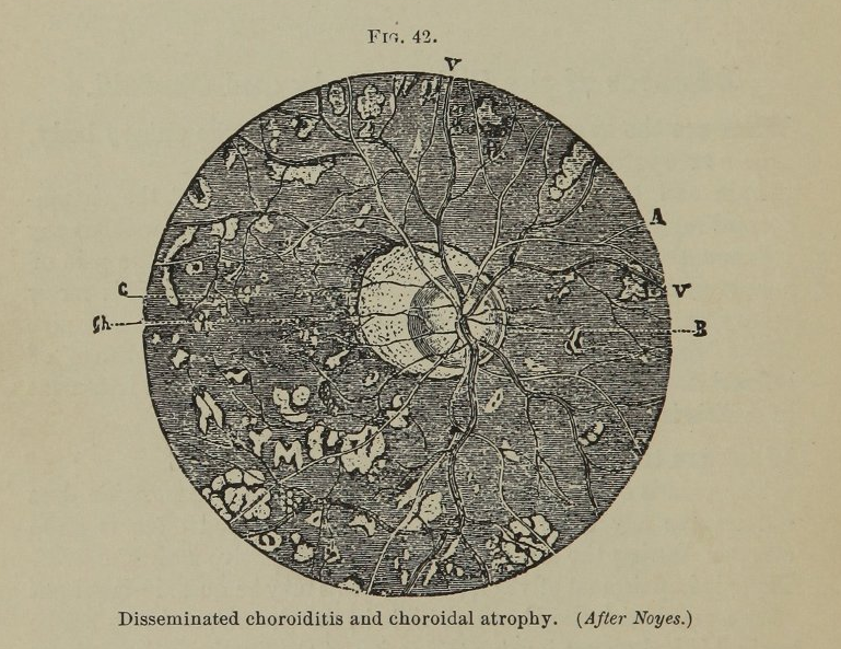  Edward Jackson, Essentials of Refraction and the Diseases of the Eye (Philadelphis: W. B. Sanders, 1890), 136, accessed U.S. National Library of Medicine Digital Collections.